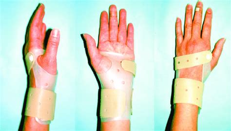 A Wrist Splint Design Custom Molded Thermoplastic Material Volar