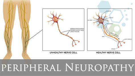 Peripheral Neuropathy Causes Symptoms And Treatment Park Group Of