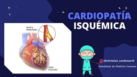 Cardiopatía isquémica CardeMedic uDocz