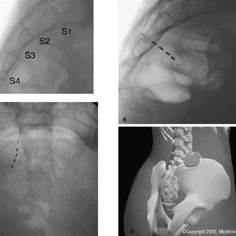 Pdf Challenges In Sacral Neuromodulation