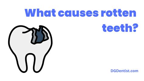 Rotten Teeth: Causes, Symptoms & Treatment - DG Dentist