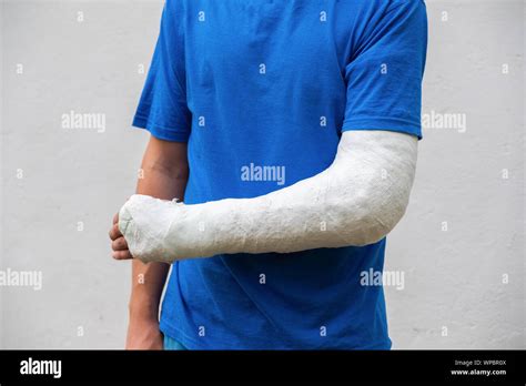 Cast Sling Hi Res Stock Photography And Images Alamy