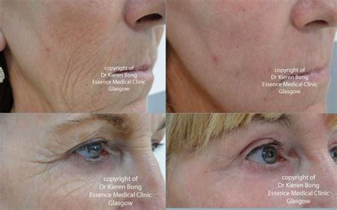 Phenol Chemical Skin Deep Peel Glasgow