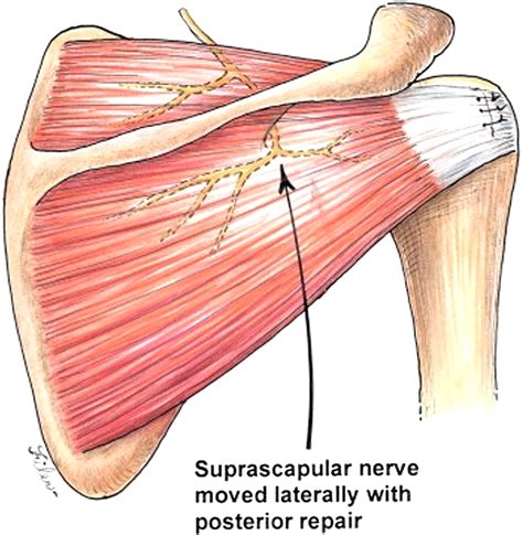 Suprascapular Neuropathy What Does The Literature Show Journal Of