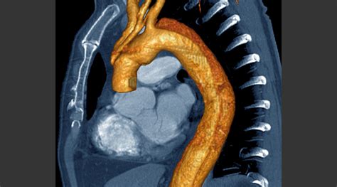 Acute Aortic Dissection Detection Risk Score Found To Have High