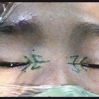 Photograph of Blepharophimosis syndrome, postoperative, case 8 ...