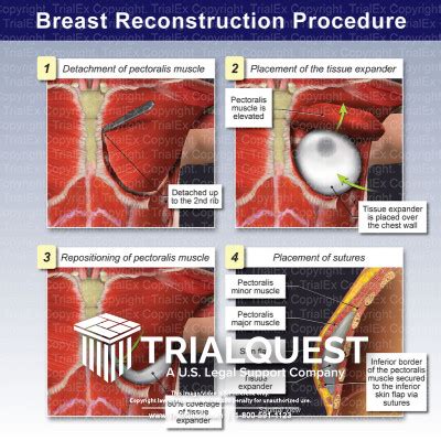 Breast Reconstruction Procedure Trialexhibits Inc