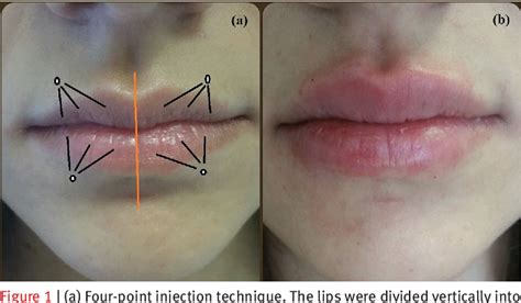 [pdf] Four Point Injection Technique For Lip Augmentation Semantic Scholar Lip Augmentation