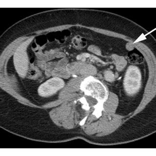 Axial Contrast Enhanced Ct Images Show A Peritoneal Deposit Within The