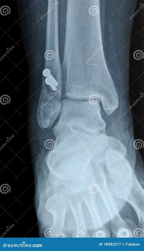 Fibula Bone Of Human On Isolated White Background Real Bone Stock