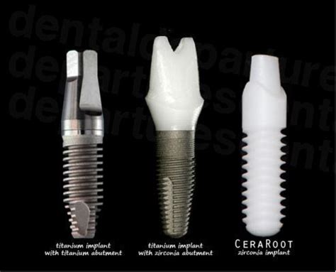 Zirconia Dental Implants - Dental Departures. Dental Departures