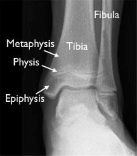 Triplane Fracture Causes Symptoms Diagnosis And Treatment