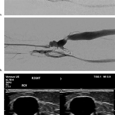 Pdf Initial Experience With The Ellipsys Vascular Access System For Percutaneous Arteriovenous