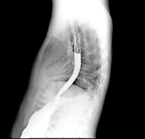 Esophagram or Barium Swallow Lateral View . Stock Photo - Image of diagnosis, medical: 161522000