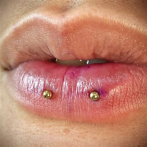 Vertical Labret Piercing Scar