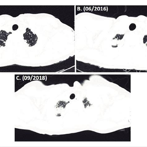 Abc Evolution Of High Resolution Computed Tomography Hrct