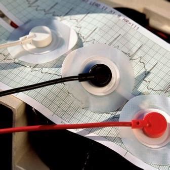 Что такое синусовая брадикардия? Причины, симптомы, лечение - АРИТМИЯ.ИНФО