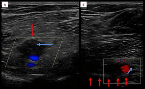 Arterial Ultrasound