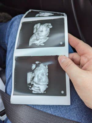 Rd Trimester Ultrasound Pics Babycenter