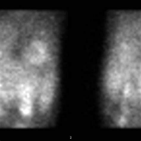 66 Year Old Male With Hiv Associated Lymphocytic Interstitial