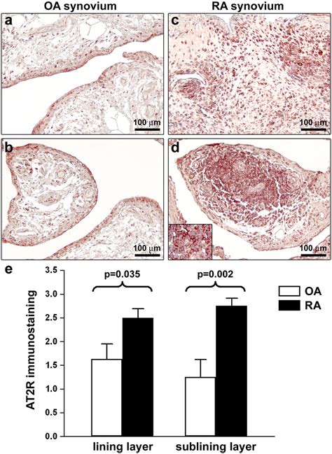 Expression Of Angiotensin Ii Type Receptor At R In Synovial Tissue