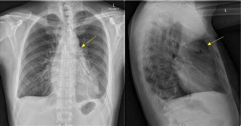 Postero Anterior Erect And Lateral Chest Radiograph Lucency Over The