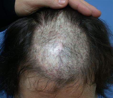 How To Treat Scar Tissue In Scalp