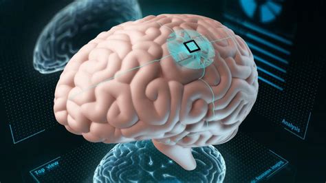 Neuralink Erster Mensch Steuert Computermaus Mit Gedanken