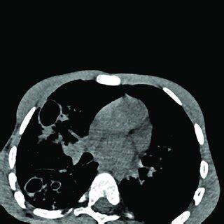 Cross Section Of A Multislice Chest Scanner MSCT Chest MSCT Native