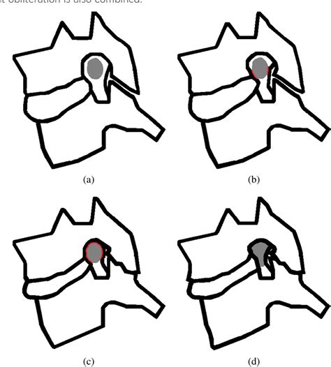 Figure 3 From A Practical Mri Grading System For Cervical Foraminal