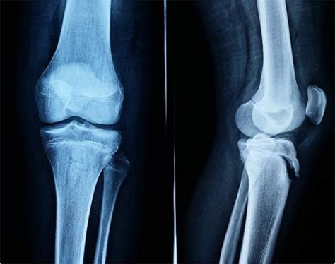 Tibial Fracture X Ray