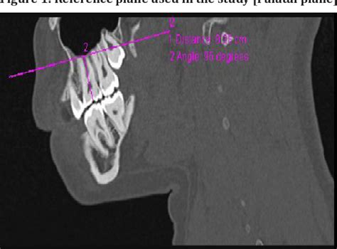 Figure 1 From Maxillary Third Molar Eruption And Its Relationship To