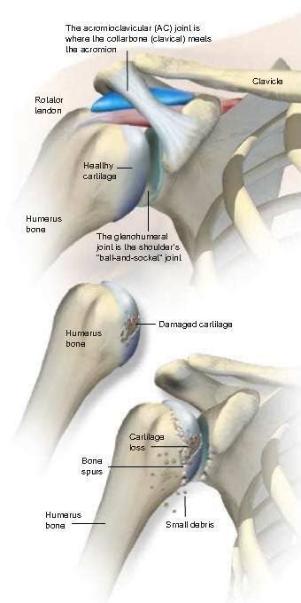 Osteoarthritis Of The Shoulder Sarasota Fl Schofield Hand And