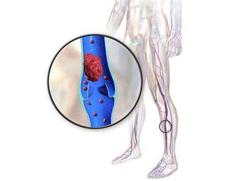 Bevyxxa Betrixaban For The Treatment Of Venous Thromboembolism Vte