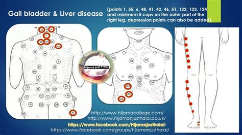 17 Best images about hijama on Pinterest | The two, Lower backs and ...