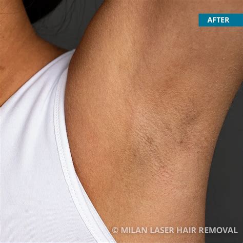 Underarm Before After Photos Of Laser Hair Removal Milan Laser In