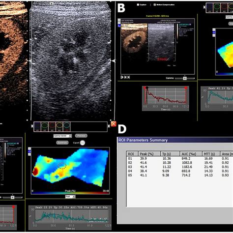 Contrast Enhanced Ultrasound Ceus Evaluations A Qualitative Ceus