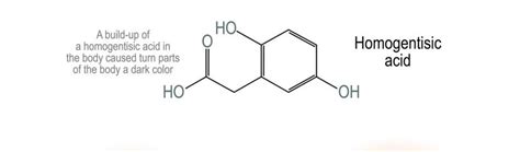 Alkaptonuria - Focus Dentistry