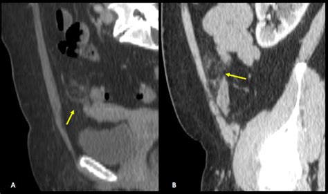 Acute Epiploic Appendagitis In Two Different Patients A B Sagittal