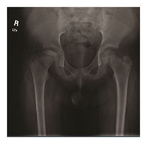 Ap Pelvis X Ray Obtained Weeks From Initial Presentation With