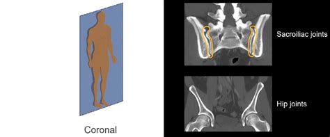 Abdominal CT: bones • LITFL • Radiology Library