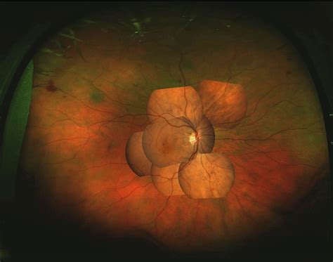 Assessment Of Diabetic Retinopathy Using Nonmydriatic Ultra Widefield Scanning Laser