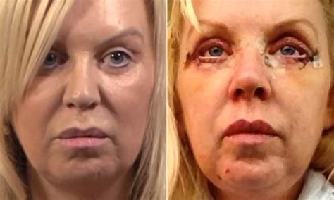 Lower Blepharoplasty Gone Wrong