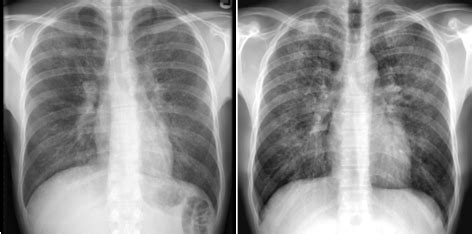 Neumonía por PNEUMOCYSTIS JIROVECI Diagnostico911 org