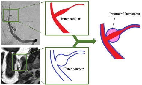 Usefulness Of Combining Ciss And Digital Subtraction Angiography In