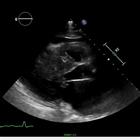 Tte Parasternal Long Axis View Tte Transthoracic Echocardiogram