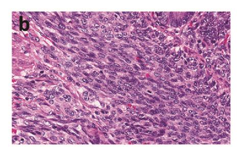 Histopathology Revealed Circumferential Spindle Cell Proliferation