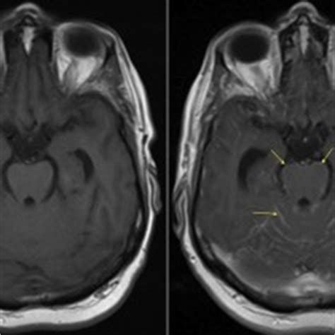 Cerebral Amyloid Angiopathy - MRI - Radiology at St. Vincent's ...