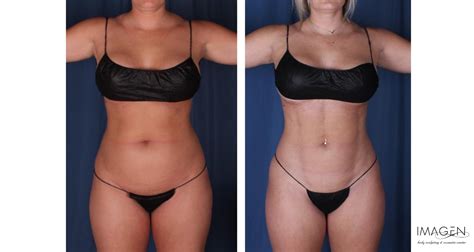 Liposuction In Omaha Ne Omaha Liposuction By Imagen