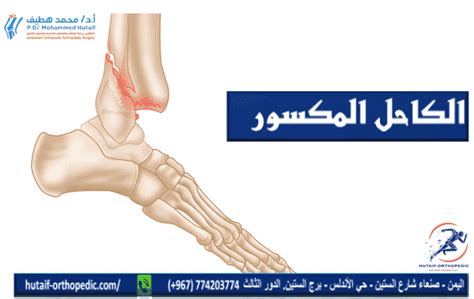 كيفية علاج كسور الكاحل والتوقعات أثناء الشفاء